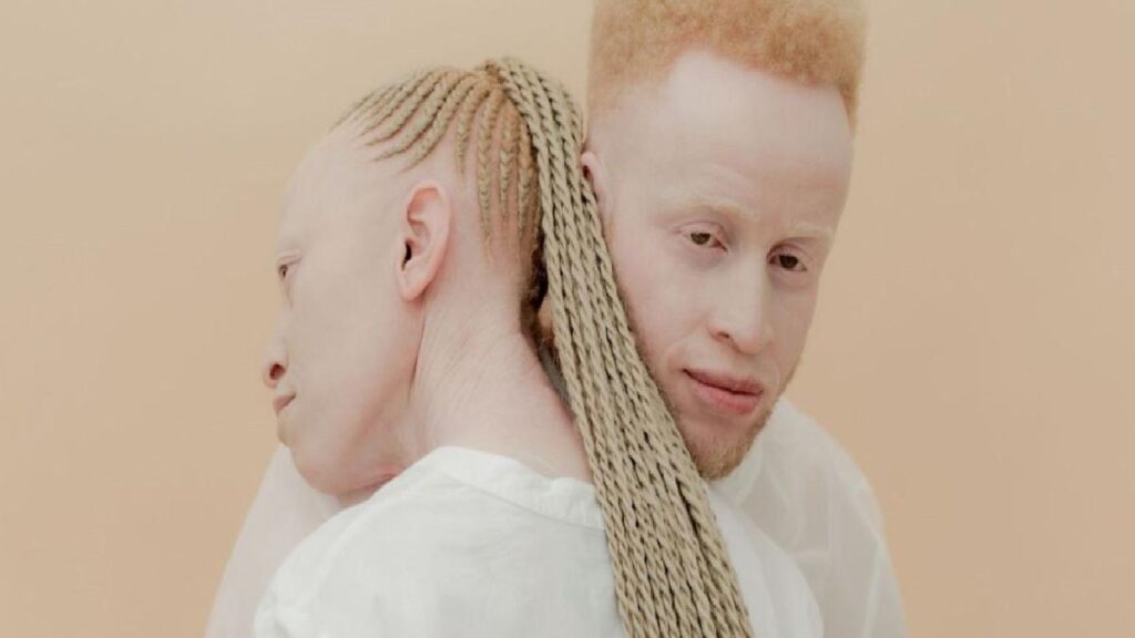 Albinizm nedir? Genetik hastalığın belirtileri, tedavisi ve toplumsal farkındalık