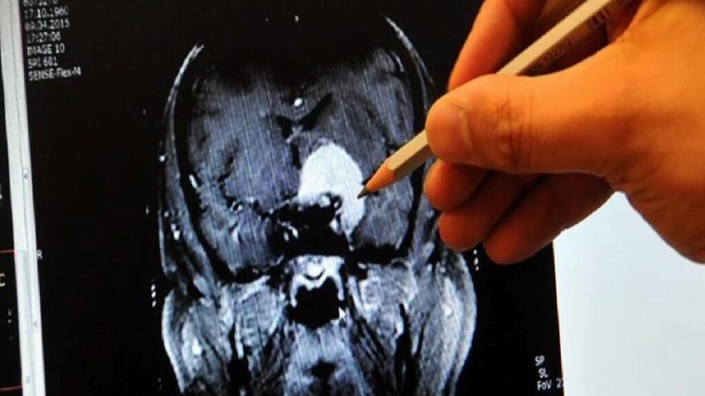 Anevrizma nedir, neden olur? Belirtileri ve tedavisi nelerdir?