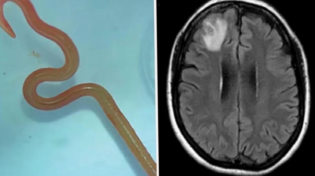 Depresyon ve unutkanlık şikayeti ile hastaneye giden bayanın beyninde 8 santimlik canlı solucan bulundu