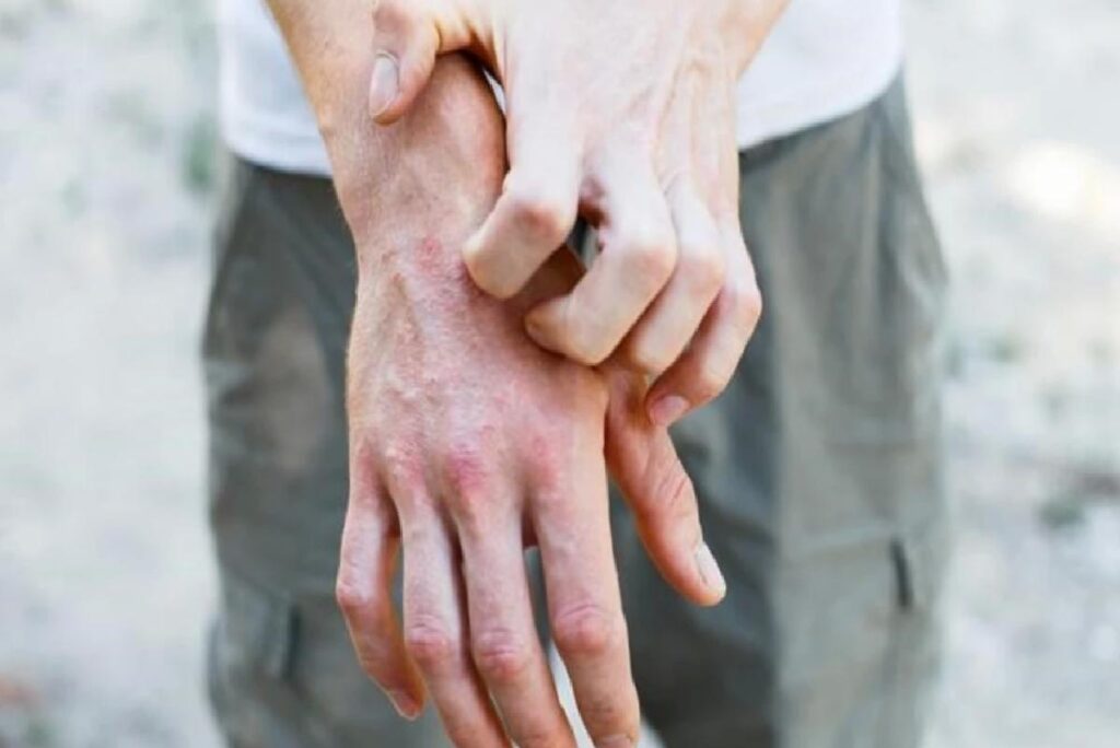 Egzama hastalığı: Belirtileri, nedenleri ve tedavi yolları