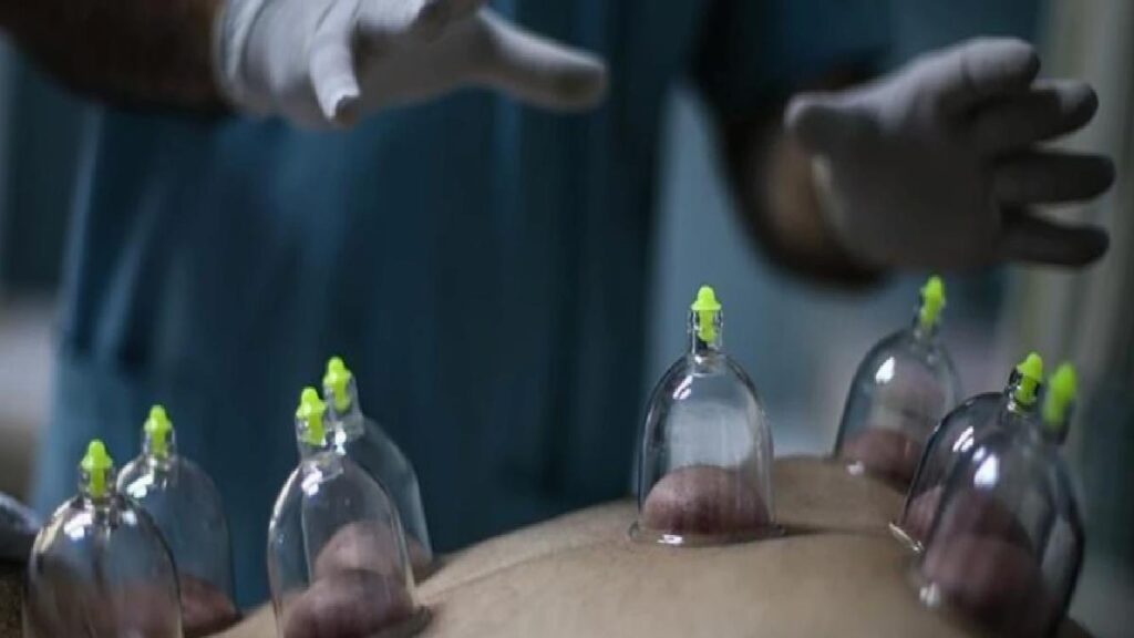 Hacamat nedir, yararları nelerdir? Hacamat günleri 2023 – 2024