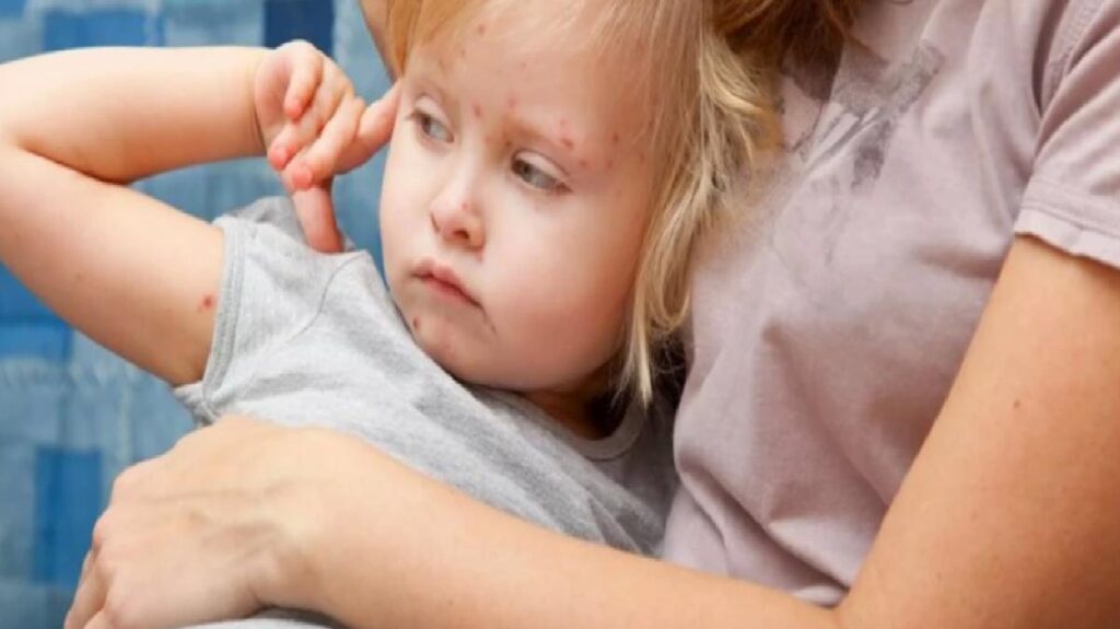 Kızamık olaylarının en yaygın olduğu 5 il! Birinci sırada İstanbul var