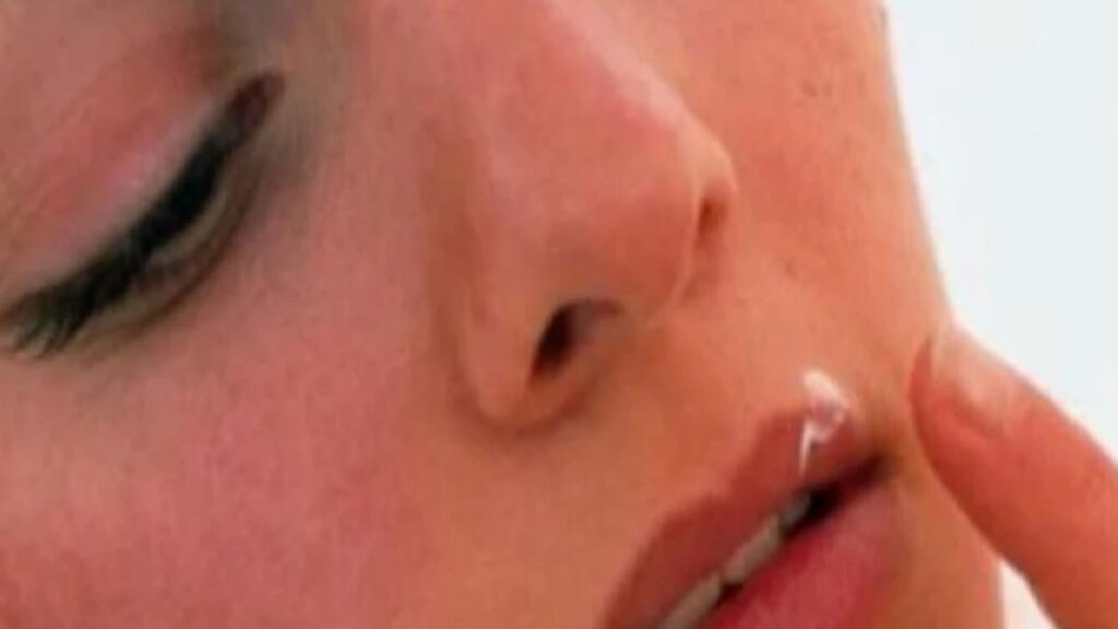 Uçuk neden çıkar, nasıl geçer? İşte uçuğun belirtileri ve tedavisi