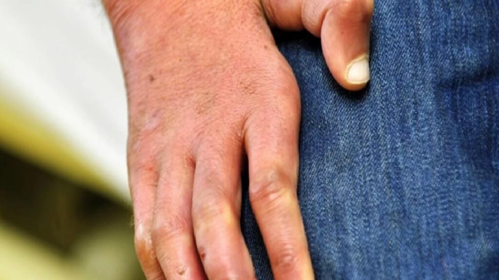 Zührevi hastalık nedir, belirtileri neler? En sık görülen zührevi hastalıklar neler, tedavisi var mı?