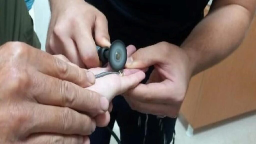 Parmaktaki yüzük itfaiye tarafından kesilerek çıkarıldı