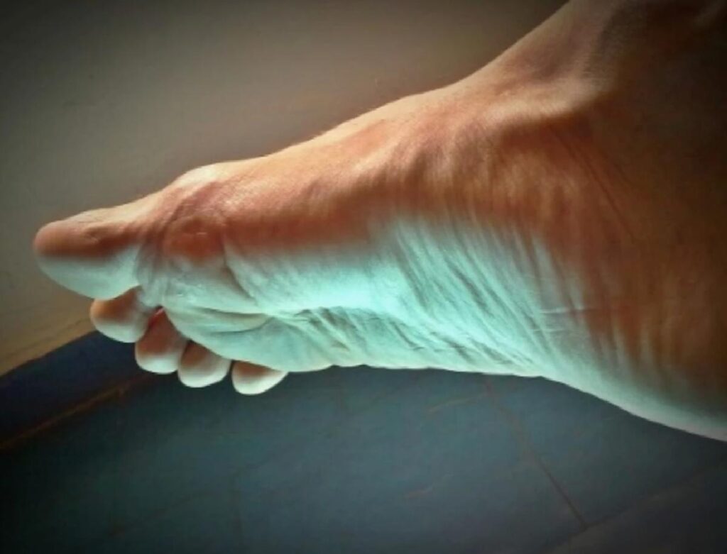 Peroneal tendon nedir? Peroneal tendon sakatlığı kaç hafta sürer?